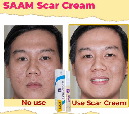 SAAM Scar Cream: Fade Minor Scars & Achieve Even Skin Tone